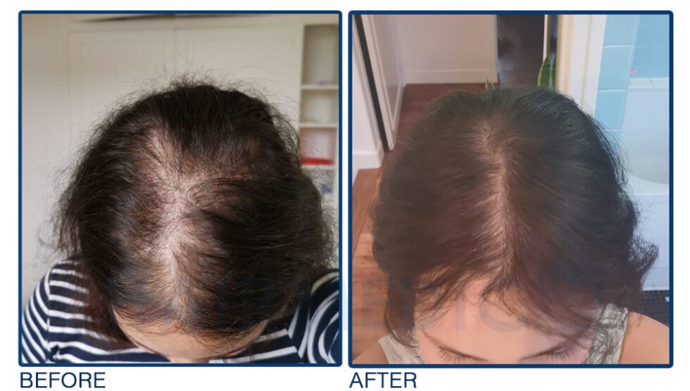 Woman Hair Transplant – LEA Clinic